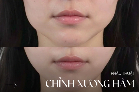 Phẫu thuật chỉnh xương hàm